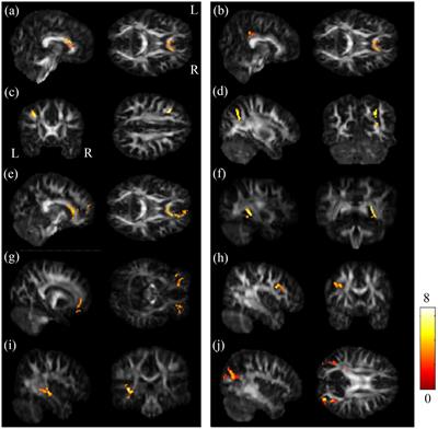 Frontiers | Detecting microstructural alterations of cerebral